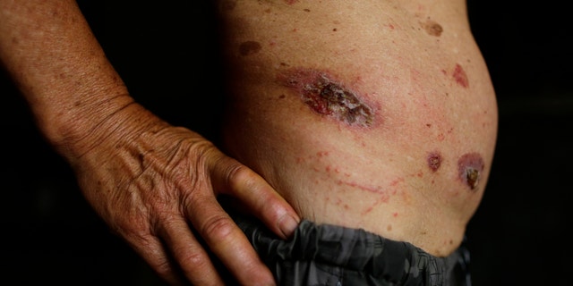 Doctors in Australia are looking for answers as they continue to investigate the Buruli ulcer "epidemic."