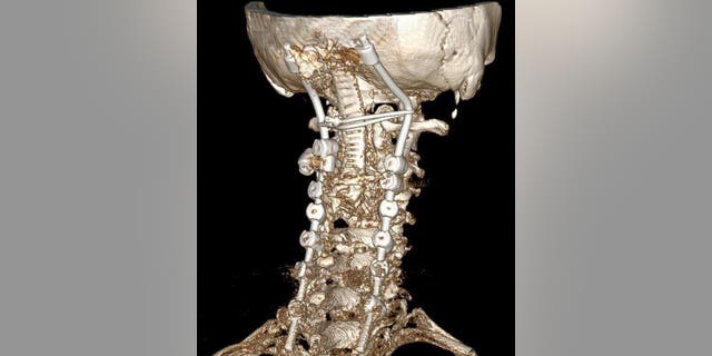 This X-RAY rendering shows what Gearing's neck will look like after the surgery.