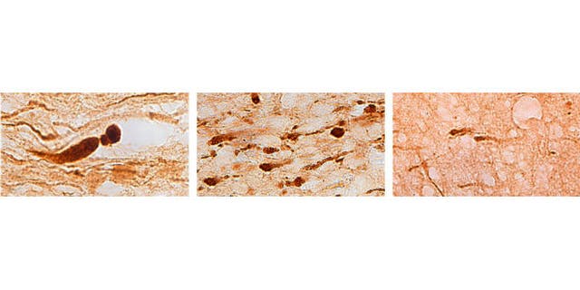 Brain sections from three different individuals show (left) axons with large, bulb-shaped lesions characteristic of a motor vehicle crash; (center) many smaller lesions characteristic of a blast injury; and (right) fewer lesions characteristic of an opiate overdose. (Credit: Vassilis Koliatsos)