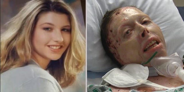 Judy Malinowski is shown before her death and after she was burned over over 80 percent of her body.