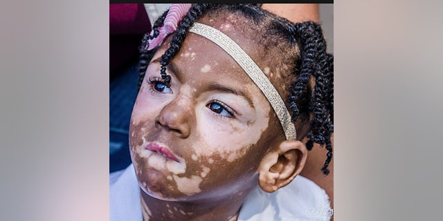 Aria Ellison developed white patches on her face and body after her dark skin began to lose pigmentation.