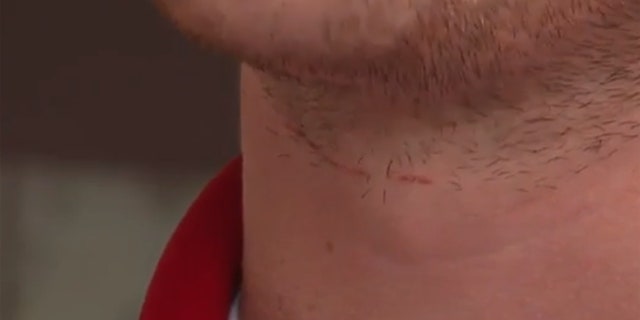 Alexander Teston said he received a cut on his neck and was nearly knocked off his motorcycle after driving into fishing line strung across a road.