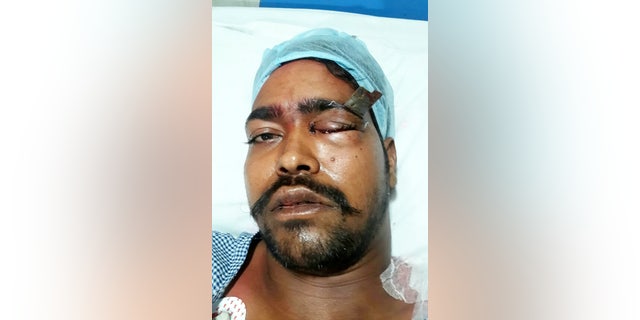 After a three-hour operation, a team of skilled surgeons were able to remove the blade from his eye.