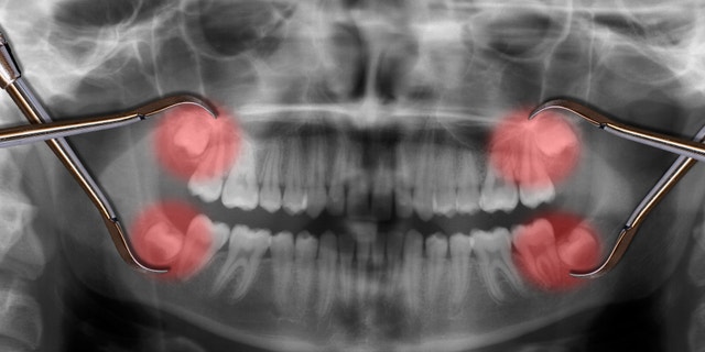 display four wisdom teeth over x-ray