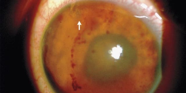 This image shows the teen's damaged right eye. The white arrow points to a translucent section of the parasitic worm. The dark spots beneath the arrow are blood.