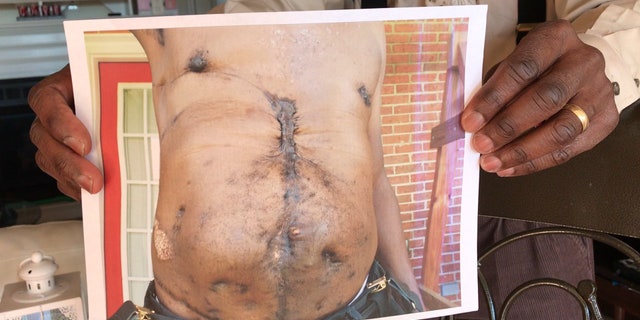 Johnson shows scars from his surgeries after the assasination attempt in 2010. Columbia, SC.