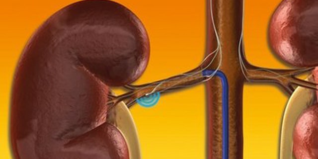 This illustration provided by Ardian's Symplicity Catheter System shows the Symplicity Catheter System, which delivers low-power RF energy to deactivate the renal sympathetic nerves.