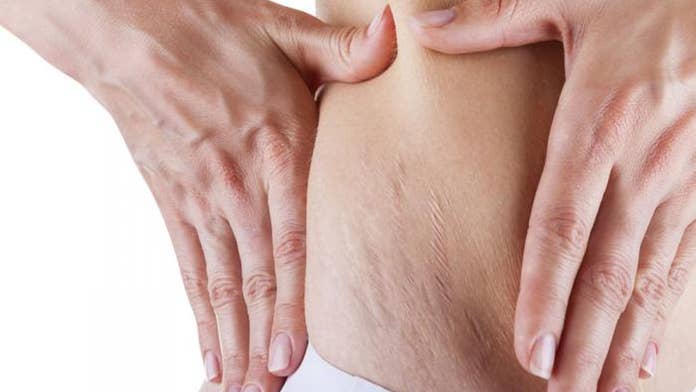 How To Get Rid Of Stretch Marks At Least Temporarily Fox News