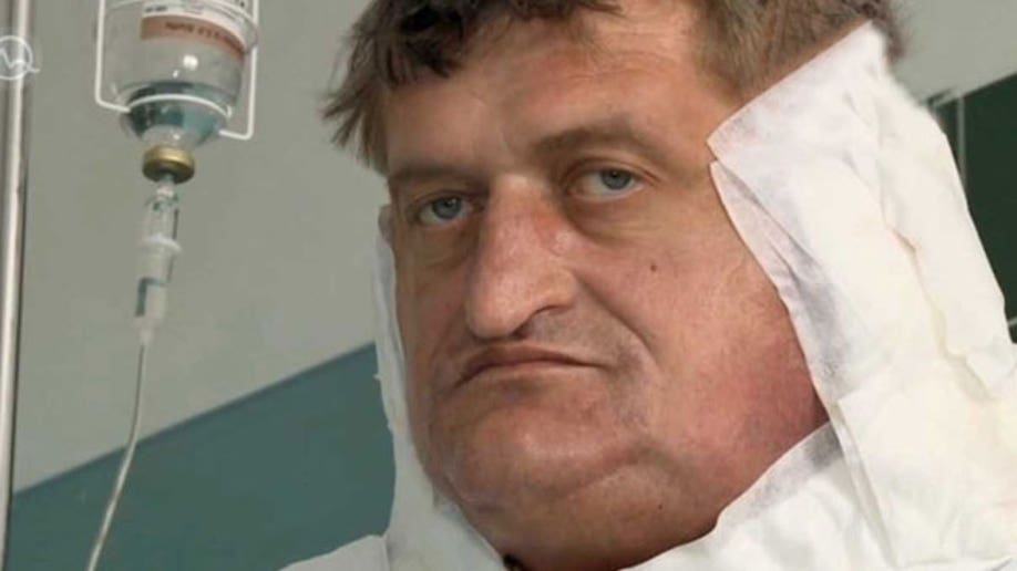 ee6b4a66-Slovak Man with One Stone Tumour Gets Final Op