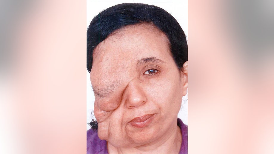 Moroccan woman with facial tumor gets life-changing reconstructive