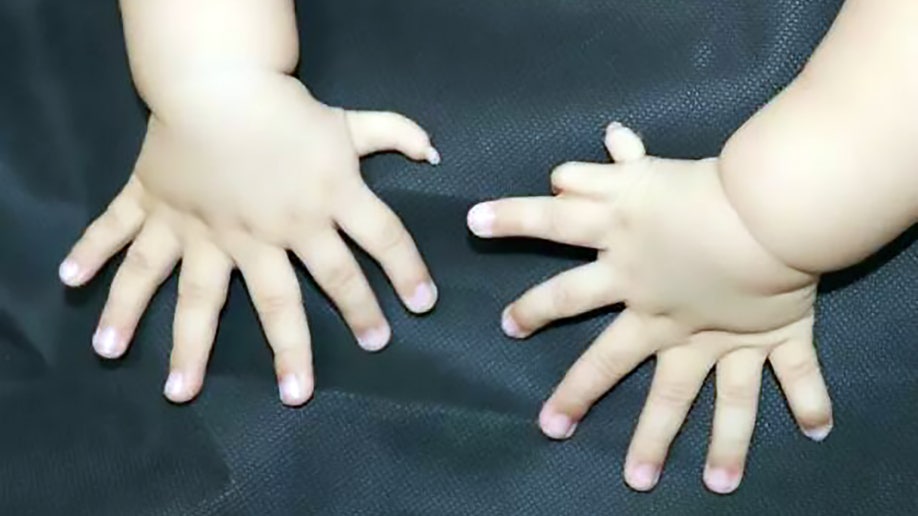 polydactyly_hands_awr