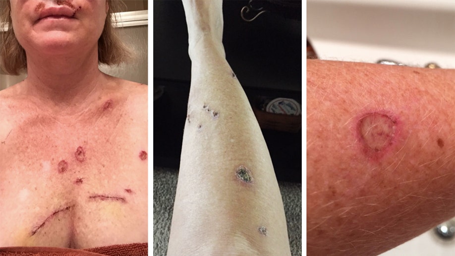 Woman Shares Skin Cancer Photos To Show Effects Of Tanning Habit Fox News
