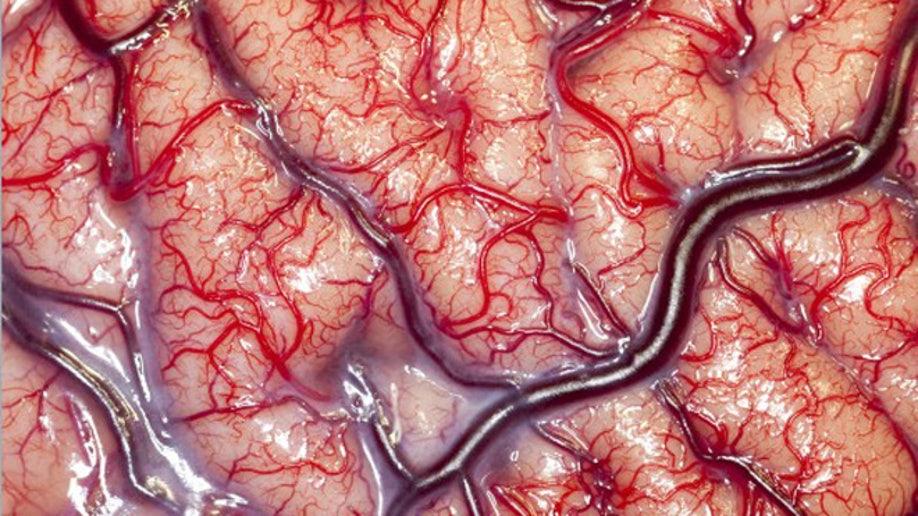 e50d499d-N0036750 Intracranial recording for epilepsy