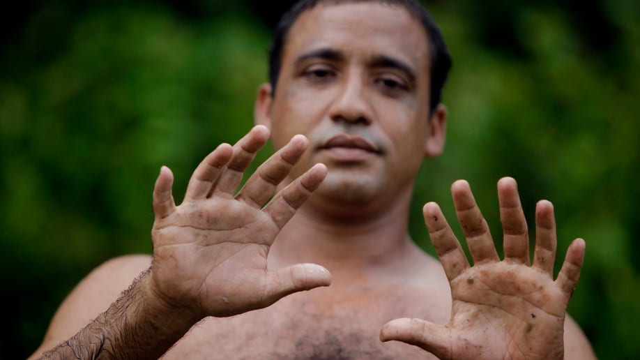 six_fingers_man
