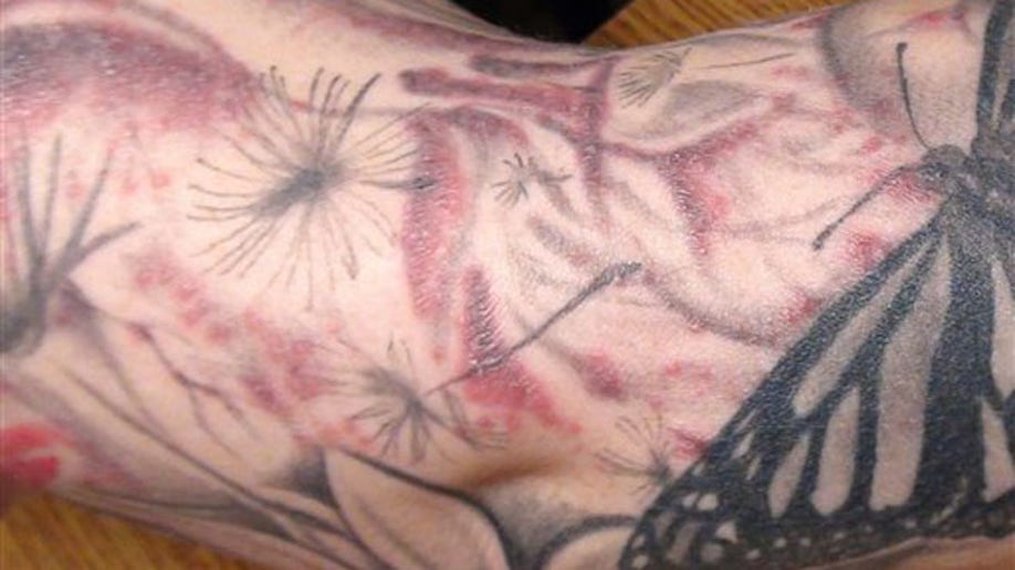 e2264c74-Tattoo Infection
