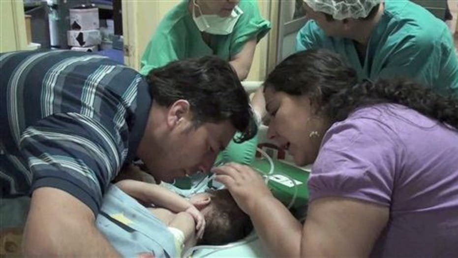 Chilean Conjoined Twins Separated