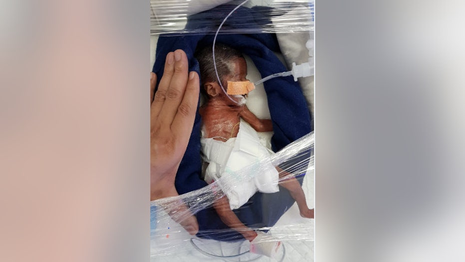 Micro Preemie Twin Babies Born At 24 Weeks Weighing 1 3 Pounds Fox News
