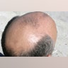 Hair Loss