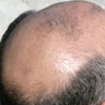 Hair Loss