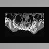 CT Scan of King Tut
