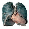 Smoker_Lung