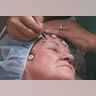 Marking the Eyelid Before Surgery