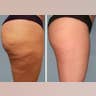 RADIESSE For CELLULITE