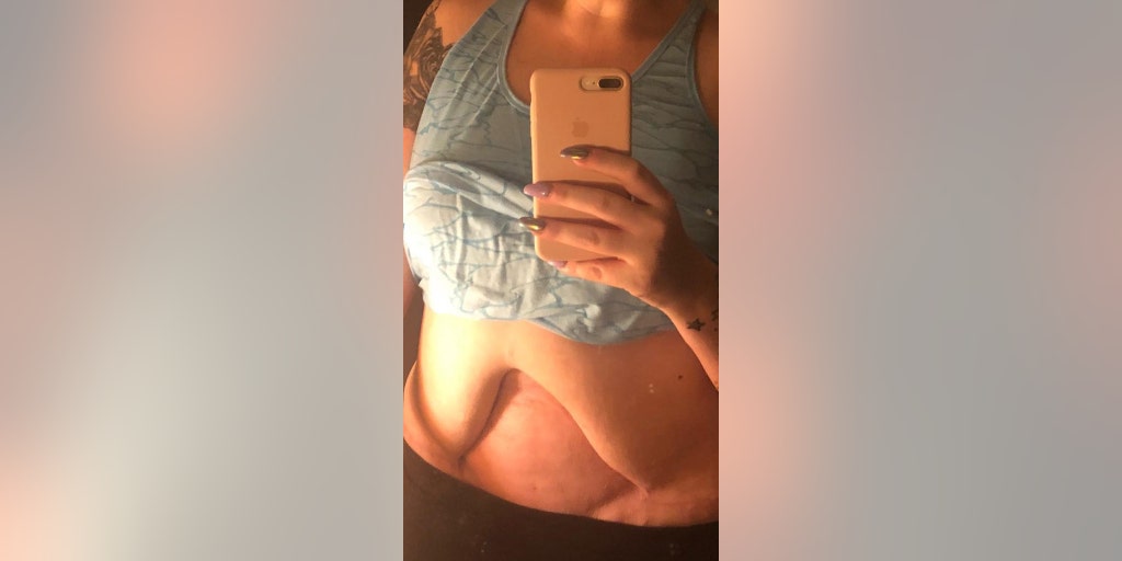 Mum left for dead after botched tummy tuck - NZ Herald