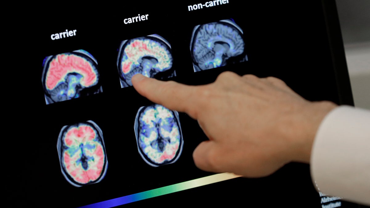 Dr. William Burke goes over a PET brain scan Tuesday, Aug. 14, 2018, at Banner Alzheimers Institute in Phoenix. (AP Photo/Matt York)