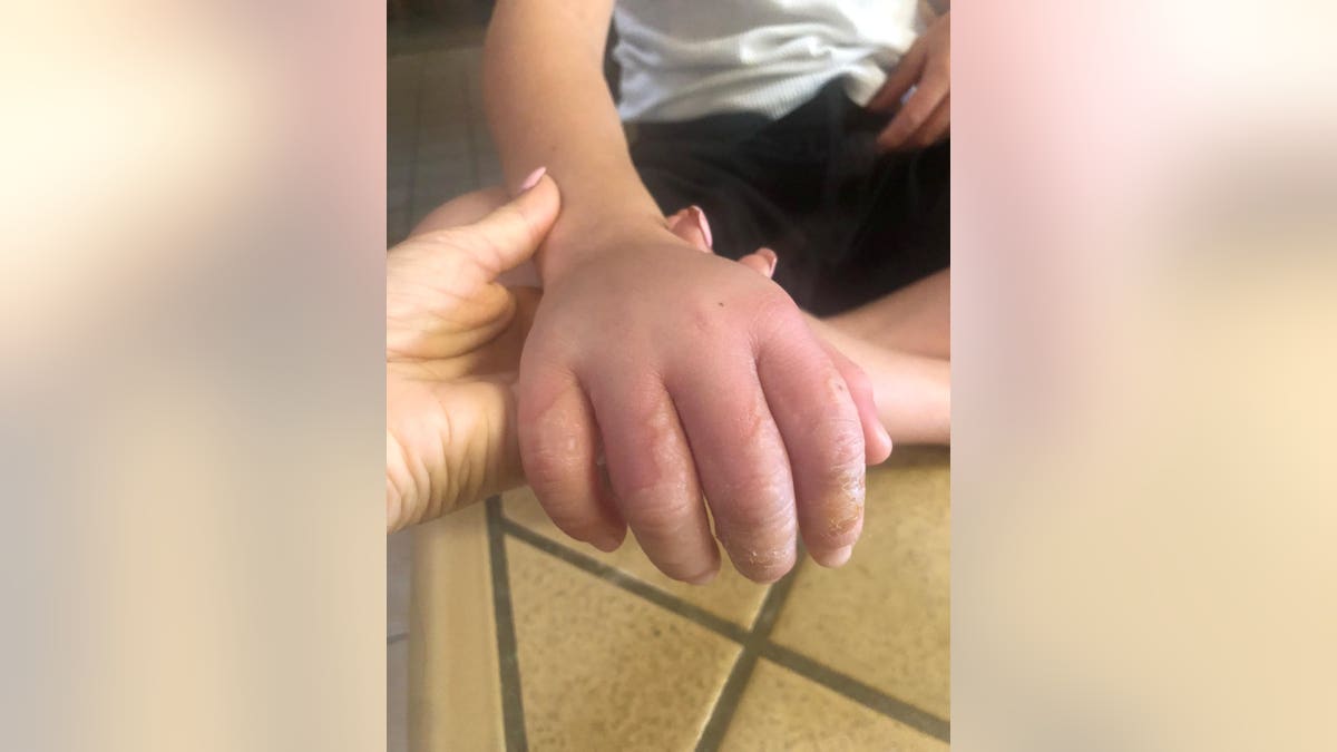 Camron Suilla suffered severe blisters and second-degree chemical burns on his body after picking limes and oranges in the sun. 