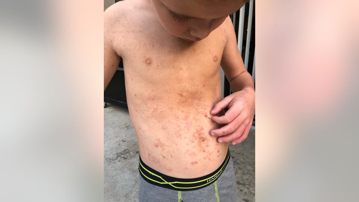 Camron Suilla severe blisters and second-degree chemical burns on his body. The boy had no symptoms at first, but three days later he complained to mom  that his right hand was stinging. 