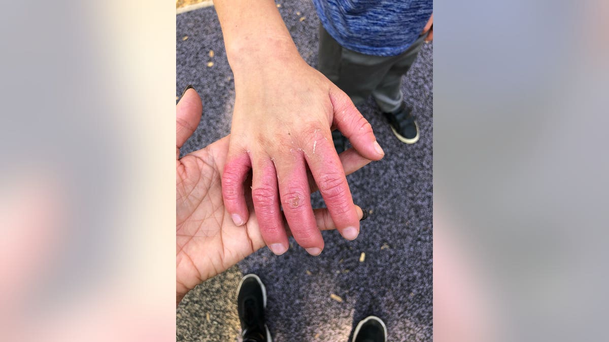 Camron was rushed to the hospital when blisters began to form on his fingers. His mom said she doesn't know if the skin will ever return to normal.