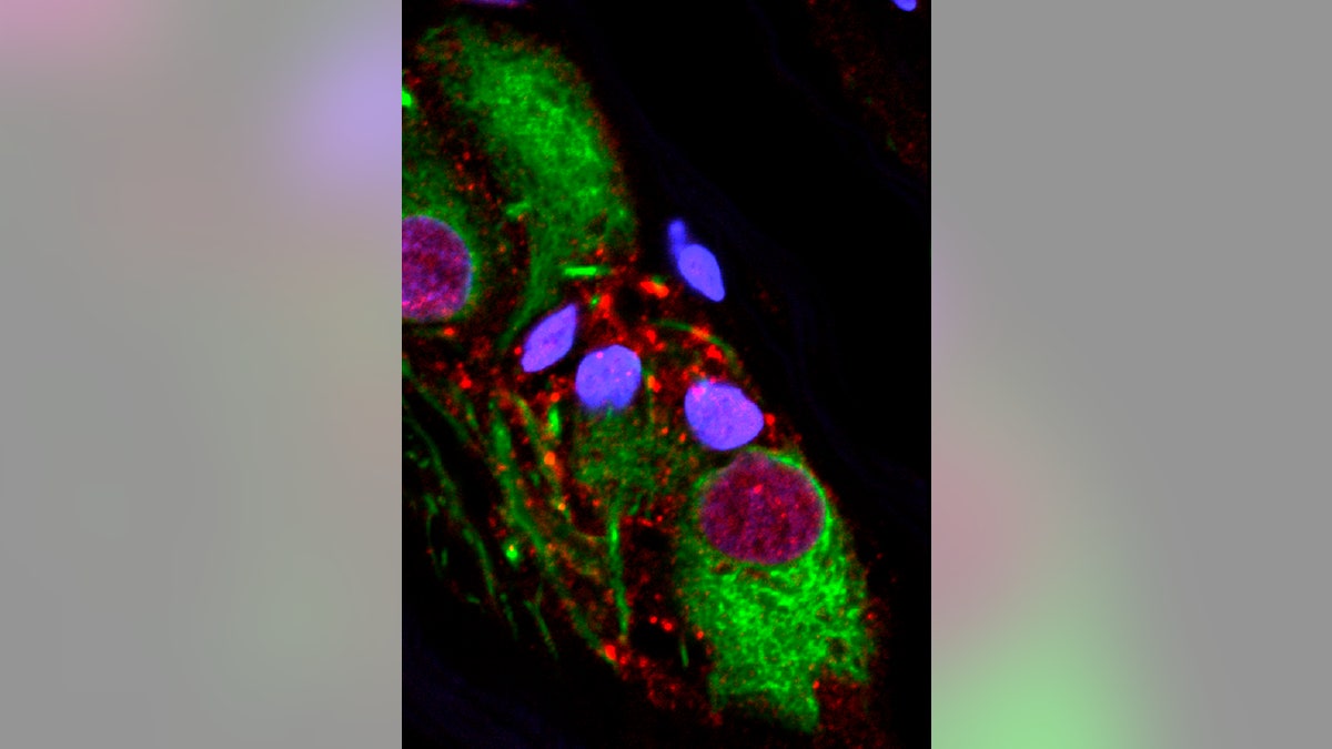 This microscope image provided by the Van Andel Research Institute in October 2018 shows an abnormal protein that is a hallmark of Parkinson’s disease clumped inside the appendix.