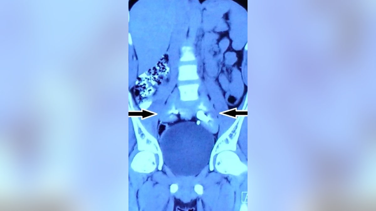 The man's "pancake kidney" is visible between the two arrows in this CT scan, sitting just above the bladder. Normally, the two separate kidneys would sit higher up in the body, closer to the top two vertebra (the white squares) that appear in the scan, and farther out to either side of the body.