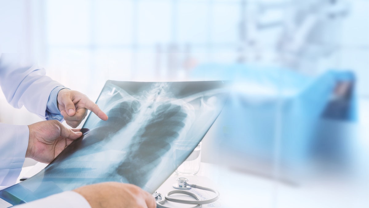Doctors examine a lung radiograph X-ray film of a patient.