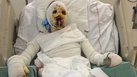 Woman's allergic reaction to penicillin leaves her with horrific burns