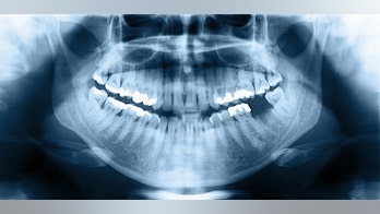 NJ man diagnosed with meningitis following routine root canal