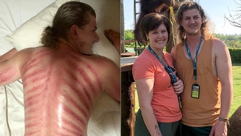 Tourist gets 'red dragon' massage in Bali, ends up with painful-looking red marks across back