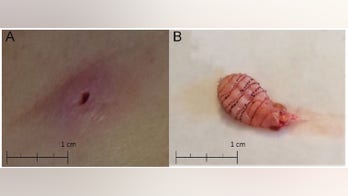 Florida newlywed discovers fly living in skin 2 months after Belize honeymoon