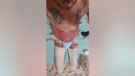 Indiana man who lost legs, penis in drunk driving crash still recovering 2 years later