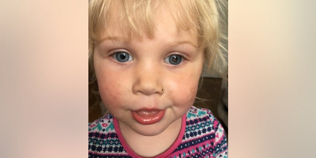 Alice Taylor, now 4, is adjusting to her new normal.