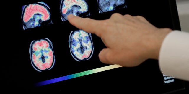Banner Alzheimers Institute in Phoenix is conducting two studies that target the very earliest brain changes while memory and thinking skills are still intact in hope of preventing the disease. 