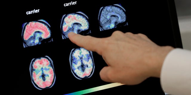 Banner Alzheimers Institute in Phoenix is conducting two studies that target the very earliest brain changes while memory and thinking skills are still intact in hope of preventing the disease.