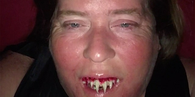 Anna Tew said her efforts to remove the fake teeth went on until around 2 a.m.