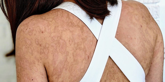 Lagier, pictured after her injuries healed, said that her symptoms started with itchy eyes and some spots on her back.