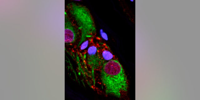 This microscope image provided by the Van Andel Research Institute in October 2018 shows an abnormal protein that is a hallmark of Parkinson’s disease clumped inside the appendix.