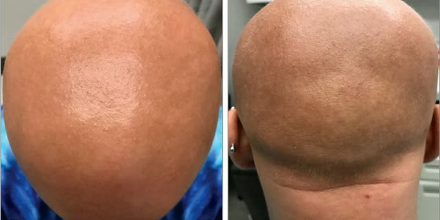 Fine light hairs called vellus hairs appear on the scalp of a patient with alopecia totalis six weeks after she began dupilumab treatment for eczema