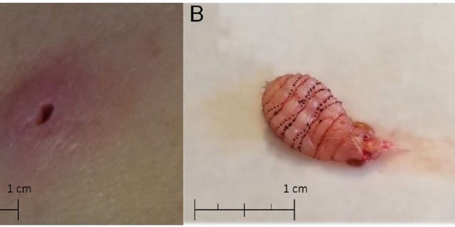 The image on the left shows the lesion on the woman’s skin. The image on the right shows the larva after it was removed. The rows of black spines make it difficult to extract.