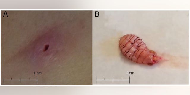 The image on the left shows the lesion on the woman’s skin. The image on the right shows the larva after it was removed. The rows of black spines make it difficult to extract.