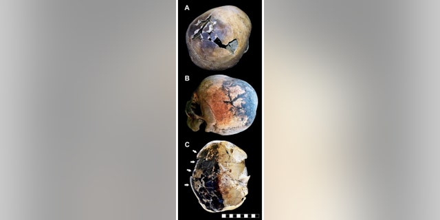 A. Skull of an older-aged adult male showing a dark stained and cracked parietal bone. B. Skullcap affected by a “stellate” fracture consisting of several cracks which radiate from a common center, characterized by charred outer margins. C. Exploded skull showing a partly dark stained inner table (right side, adult male; charring of the fractured margins is evident (white arrows). The skull of this victim was lying in the ash bed on its left side. (Credit: PLOS)